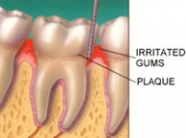 gingivitis