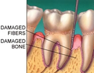 periodontitis