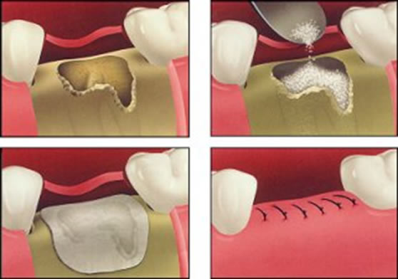 bonegraft1