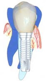 dentalimplants