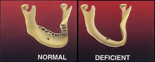 jaw augmentation